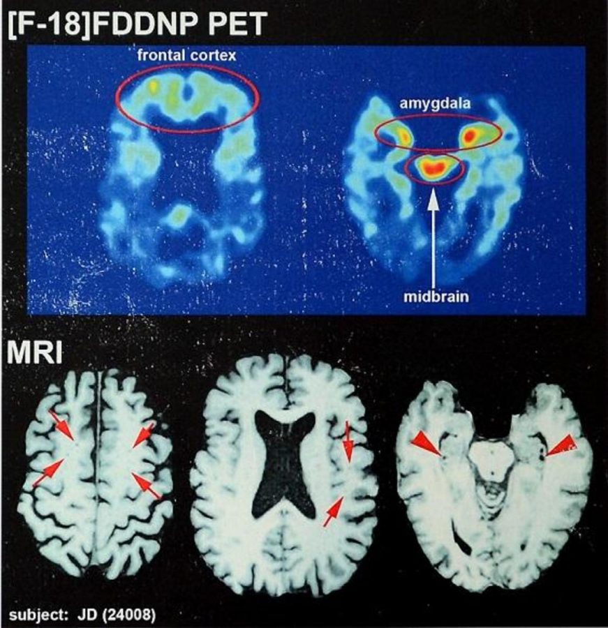 Recent brain scans of NFL hall of famer Joe DeLamielleure show CTE. This brain disease affects hundreds of football players over the years. CTE was first introduced as a major concern in the 1920s. 